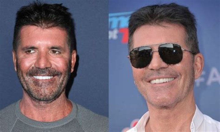 Does Simon Cowell Have Veneers?